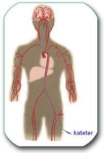 Subtrakciona digitalna angiografija- SDA- Uvodjenje katetera u arteriju noge odakle se on, kroz arterije trbuha, grudnog koša i vrata uvede u arterije mozga. Tada se one, preko ovog katetera, ispune kontrastom (jodni preparat) i snime.