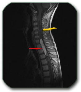 Spinal MRI shows a spinal cord tumor (ependymoma – red arrow) which causes cysts to form within the cord both above and below the tumor (yellow arrow).