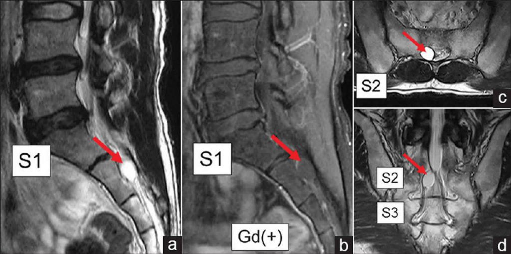 the arrow points to a Tarlov cyst on the spinal MRI scan