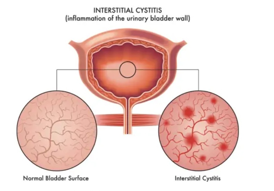 Cross-sectional diagram of a normal bladder lining compared to inflammation in interstitial cystitis