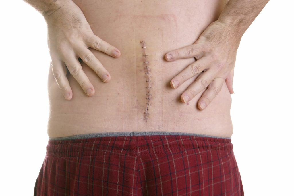 Illustration of  Post-laminectomy syndrome.