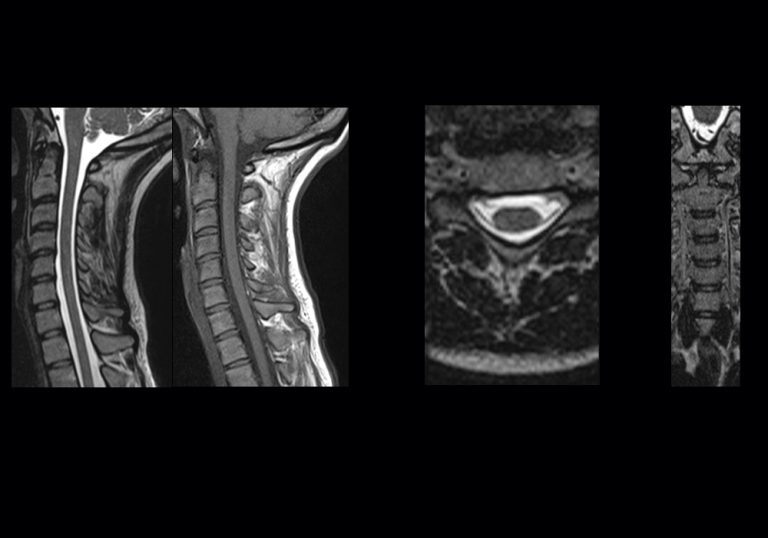 MRI of the cervical spine in a patient with chronic neck pain showing moderate degenerative changes that are actually not the cause of the symptoms. The true pain generator was trapezius enthesopathy (middle fibers) at the medial attachment over the C7 spinous process (a ~1 cm localized focus) — a point-precise generator that routine MRI scans frequently miss.