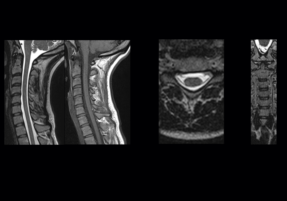 MRI of the cervical spine may show moderate degenerative changes that are actually not the cause of neck pain. The real reason can be inflammation of the medial attachments of the middle bundles of the trapezius muscle, which are not visible on MRI.