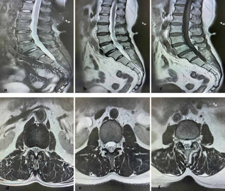 MRI of the lumbar spine may show moderate degenerative changes that are actually not the cause of low back pain. The real reason can be inflammation of posterior ligament attachments of the sacroiliac joints, which are not visible on MRI.