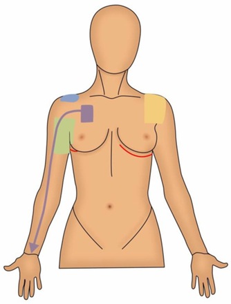 Post-mastectomy Pain Syndrome