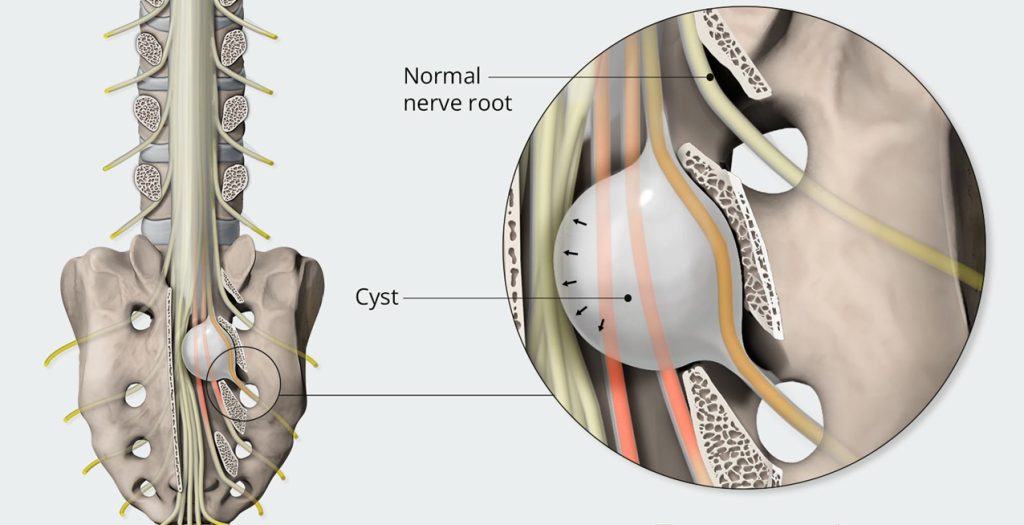 Image of Tarlov cyst in sacral canal