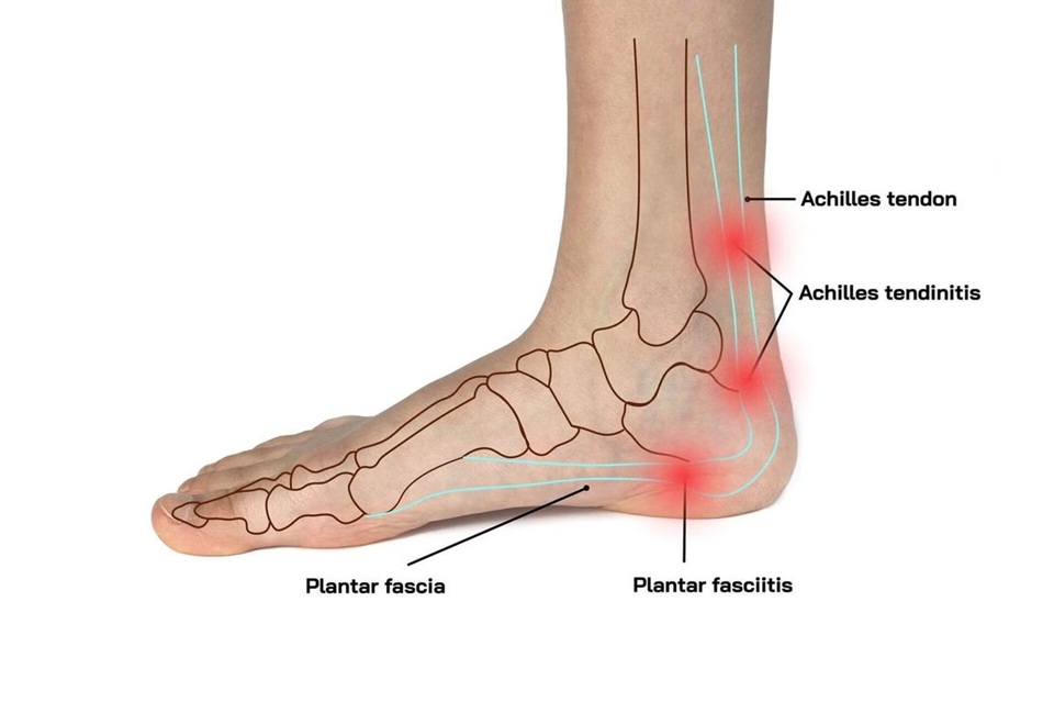 Achilles tendinitis and plantar fasciitis