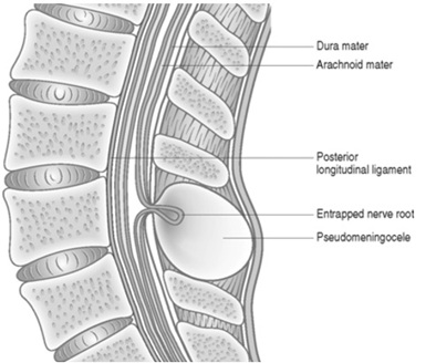  CSF leak / pseudomeningocele after spine surgery