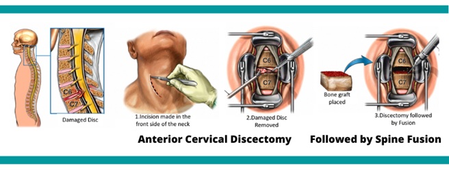 Surgical illustration of anterior cervical discectomy and fusion (ACDF), showing removal of the disc and placement of an interbody cage or bone graft.