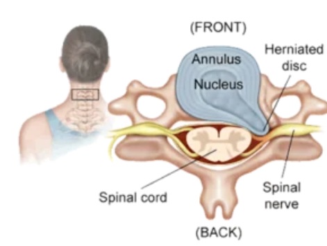 A cervical vertebra showing an intervertebral disc with a herniation. The nucleus pulposus (the soft inner part) has penetrated the anulus fibrosus (the tough outer ring) and is compressing the nerve root.