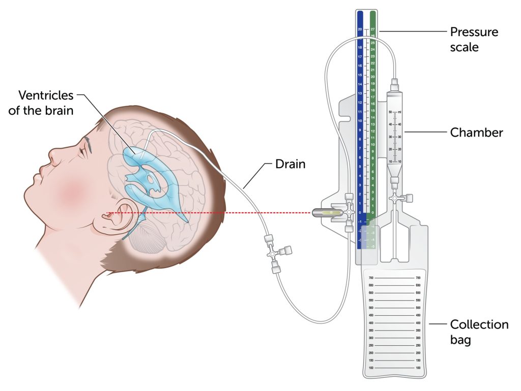 Placement of an external ventricular drain (EVD) for monitoring and lowering intracranial pressure