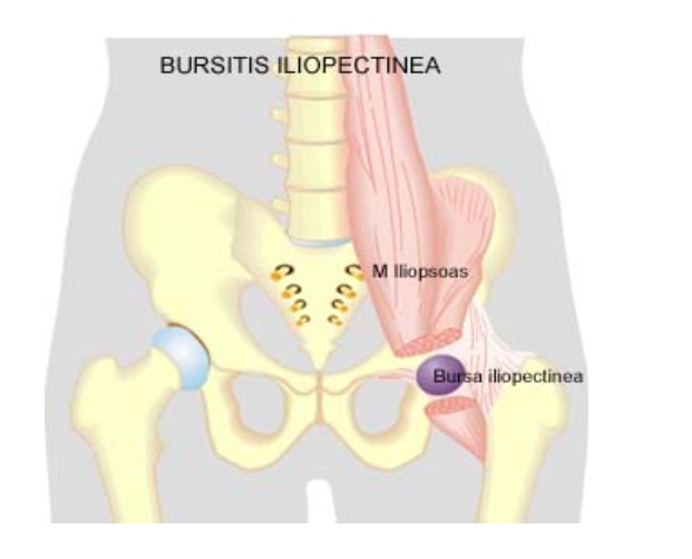Iliopsoas or IT-band–related syndromes