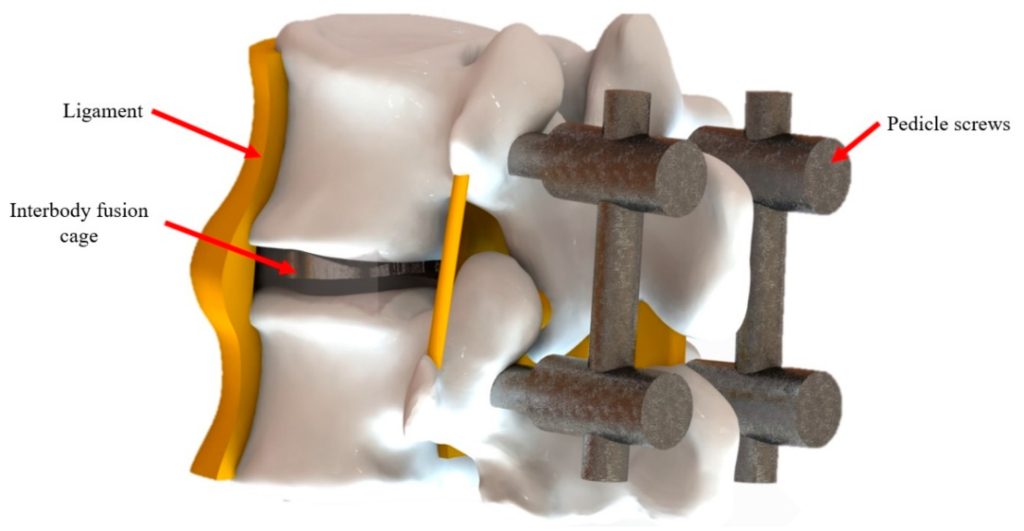 Interbody fusion with cage placement and posterior screws for spinal stabilization
