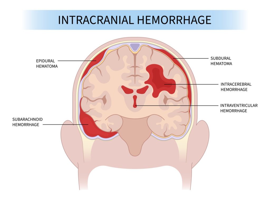 Types of traumatic intracranial hematomas