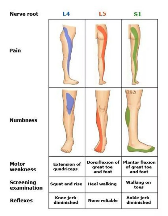 Demonstration of pain and neurologic deficits for radiculopathies L4, L5 and S1