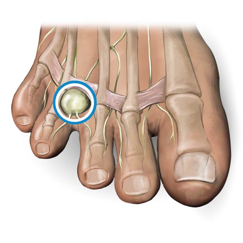 Morton’s neuroma between the 3rd and 4th metatarsal heads