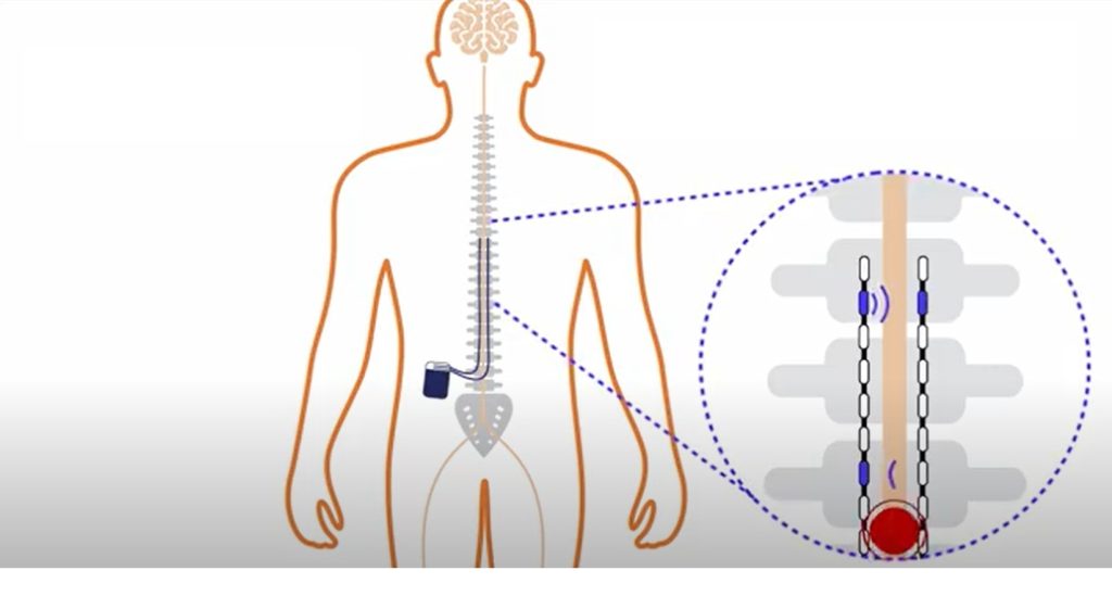 Spinal Cord Stimulators (SCS) 