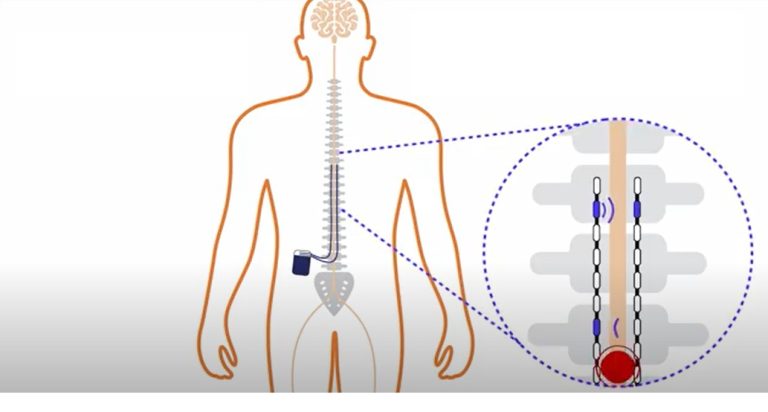 Stimulacija kičmene moždine u lečenju bola nakon operacije diskus hernije