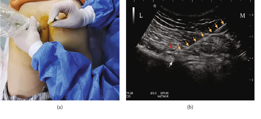 Ultrasound-guided pudendal block. a) performance b) ultrasound image showing needle and target