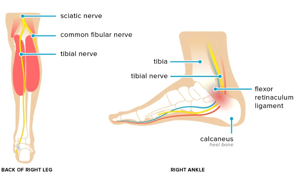 Tarsal tunnel syndrome — compression of the posterior tibial nerve beneath the fibrous bend (flexor retinaculum) behind the inner (medial) ankle.