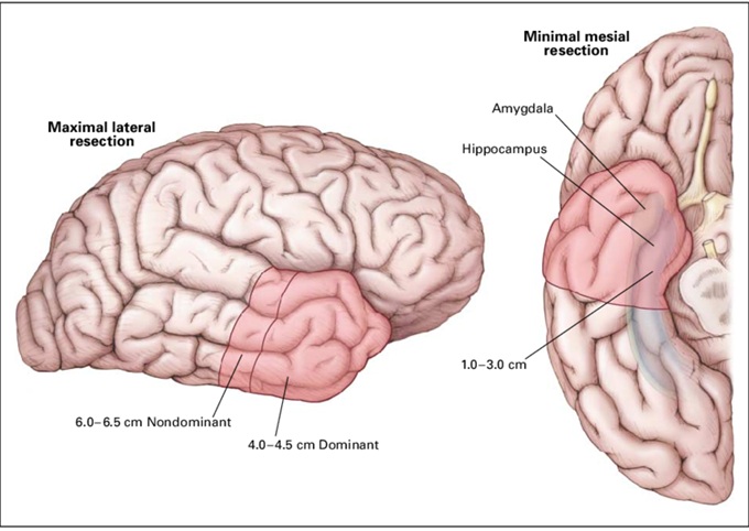 Anterior temporal lobectomy (ATL)