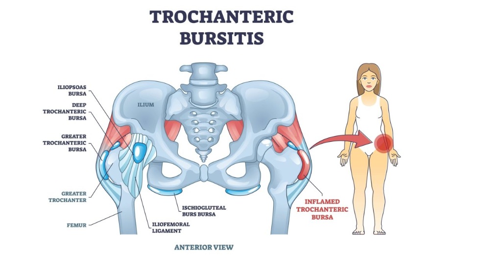 Greater trochanteric pain syndrome (GTPS), showing hip bursae and gluteus minimus and medius tendons.