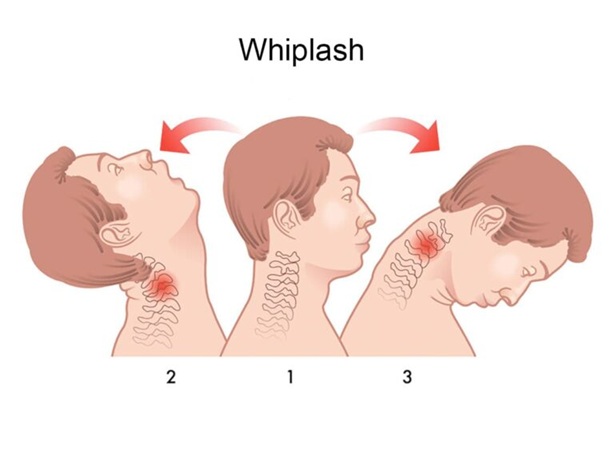 Sequence of cervical motion during a vehicle collision — neutral position (center), hyperextension phase (rear impact), and hyperflexion phase (front impact).