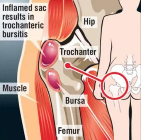 Hip Anatomy and Trochanteric Bursitis