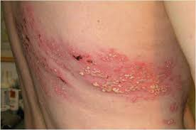 Skin changes in herpes zoster