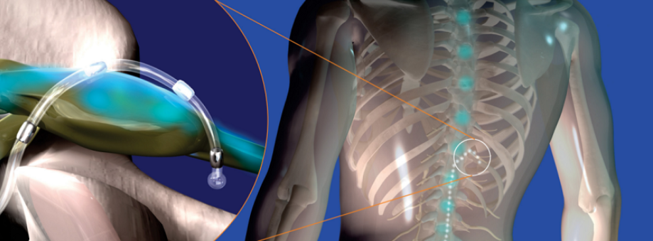 A micro-lead wire for stimulation is positioned around the Dorsal Root Ganglion (DRG), which is the specific control center for the painful nerve.