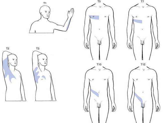 Pain locations with intercostal neuralgia at different levels. If this isn’t suspected, patients may think the pain is coming from the breast, heart, liver, stomach, or other organs — which often leads to extensive testing of those organs.
