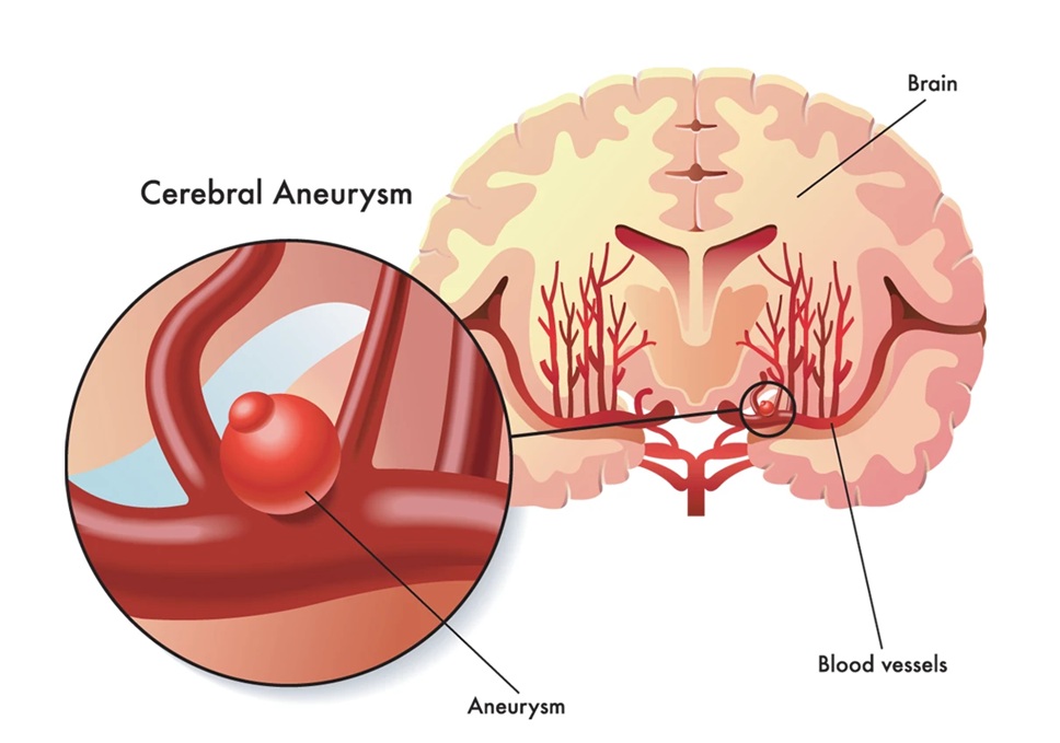 Aneurysm (saccular dilation) at arterial bifurcation in the subarachnoid space at the base of the brain.