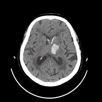 deep (thalamic) hematoma that has penetrated the ventricle, appearing white (hyperdense) on the CT scan.
