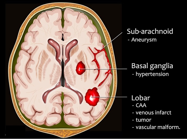 Location and the most frequent causes of intracerebral hemorrhage (superficial/lobar and deep/basal ganglia), as well as subarachnoid hemorrhage.