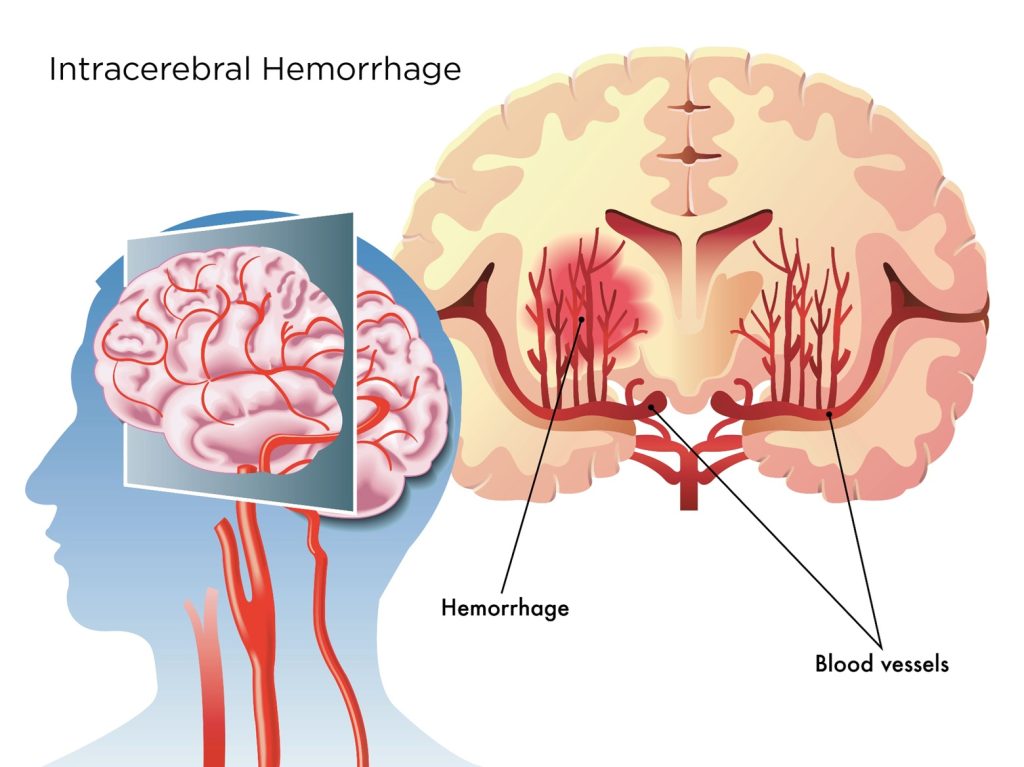 Chronic small-vessel diseases that weaken penetrating arteries (true spontaneous ICH)
