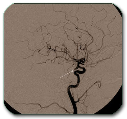 DSA (angiography) showing brain arteries with the aneurysm marked by an arrow.