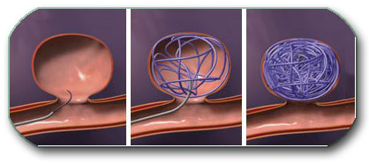 Filling of the aneurysm with coils (aneurysm coiling). This is performed using the same technique as DSA (angiography), meaning without opening the skull.