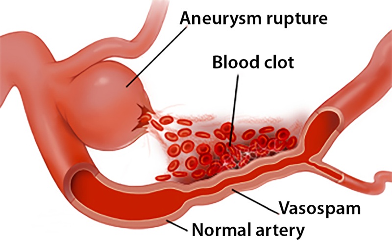 Blood in SAH Causing Vasospasm and Artery Narrowing.