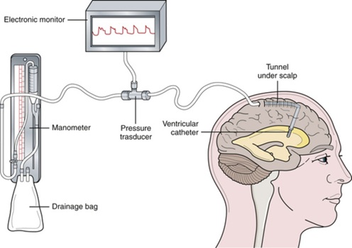 External Ventricular Drain EVD Simple Explanation For Families External Ventricular Drain EVD Simple Explanation For Families