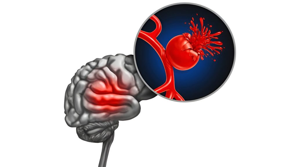 Aneurysm rupture and SAH