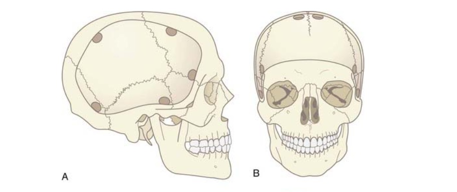 The two main types of decompressive craniectomy: (A) Unilateral craniectomy, most commonly performed during SDH evacuation when significant brain swelling is present, and (B) Bifrontal craniectomy, performed when there is swelling on both sides of the brain, as seen in cases of diffuse DAI.