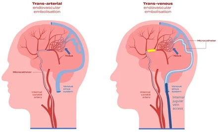 Endovascular embolization techniques. The left side shows the common transarterial approach, while the right side shows the transvenous approach.
