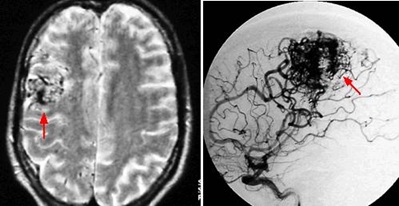 The red arrow on the left shows a brain AVM on an MRI scan. The red arrow on the right shows the same AVM case on a DSA.