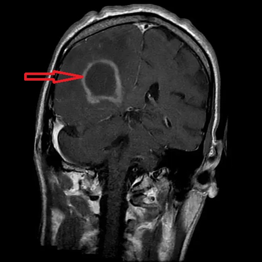 MRI scan of the brain where a red arrow points to a primary CNS lymphoma in an immunocompromised individual, closely mimicking the appearance of a glioblastoma.