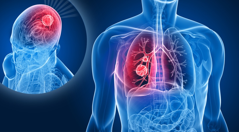 Brain metastasis originating from lung cancer