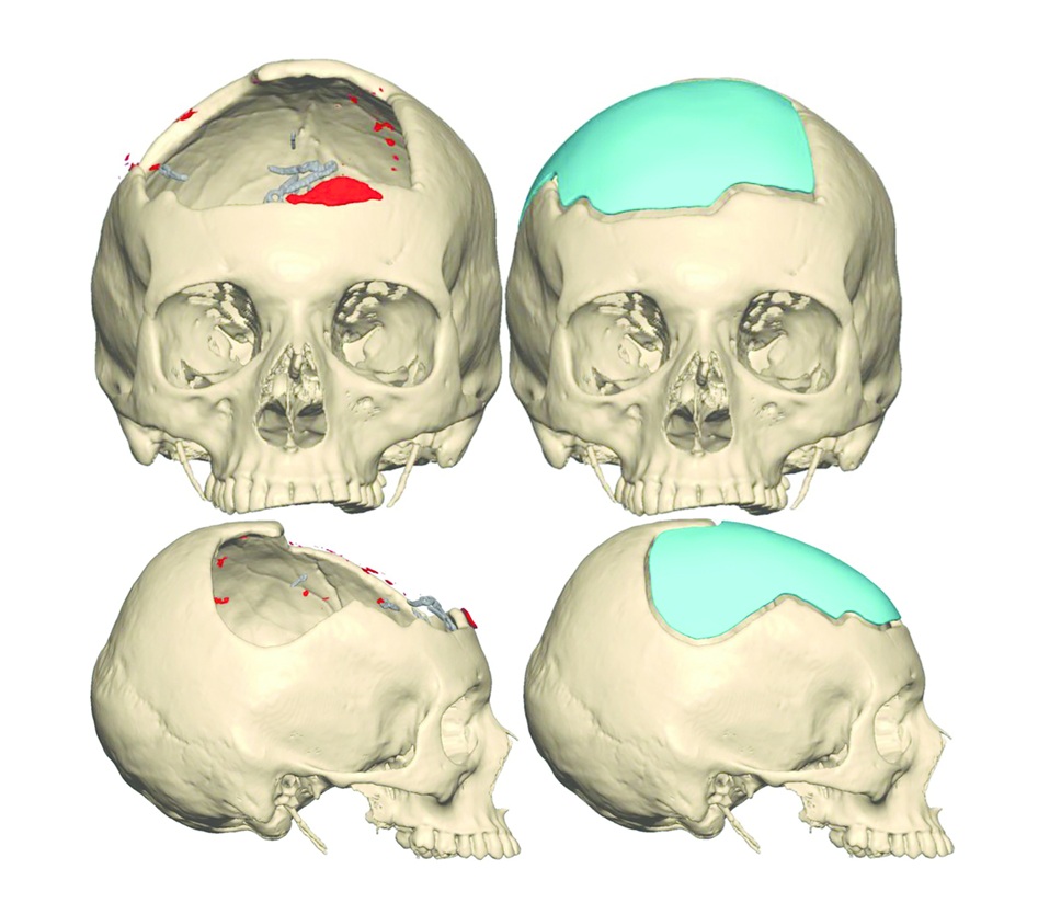 Cranioplasty procedure showing the replacement of a missing skull segment using a custom-made, 3D-printed implant.