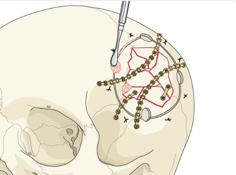 Intraoperative view showing the bone fragments after they have been correctly realigned and securely fixed together.