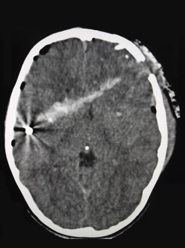 CT scan of a gunshot wound showing the entry site in the left frontal region, the bullet track (hyperdense white line due to blood in the wound canal), intracranial air (pneumocephalus), and the retained projectile in the right parietal region.