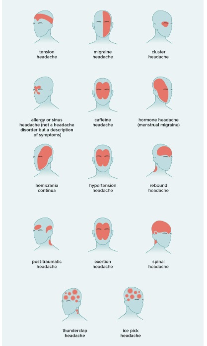 Typical pain distribution in common primary headache disorders