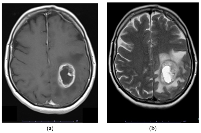 (A) T1-weighted MRI with contrast showing a glioblastoma (GBM) in the left hemisphere; the tumor exhibits a bright white ring of contrast enhancement at the periphery, with a darker center due to internal necrosis. (B) T2-weighted sequence showing the same lesion with extensive surrounding peritumoral edema, which appears as a bright white (hyperintense) area.